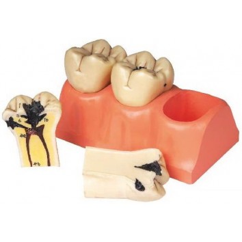 DISSECTED MODEL OF DENTAL CARIES